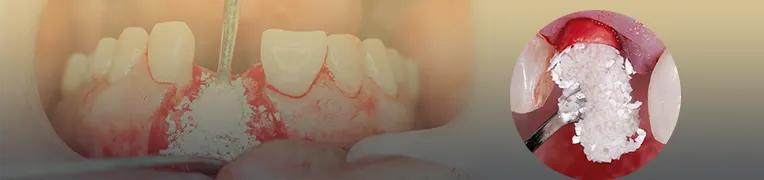 پیوند استخوان دندان