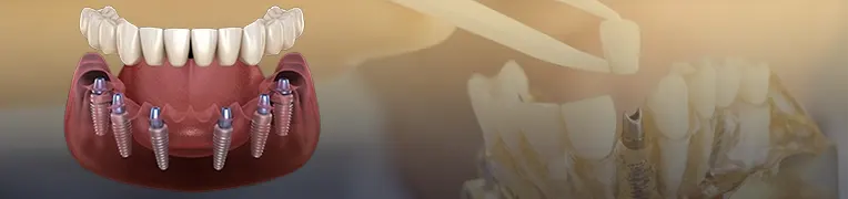 کیفیت ایمپلنت