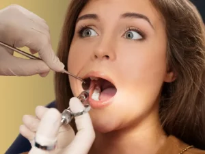 لمینت دندان عصب کشی شده