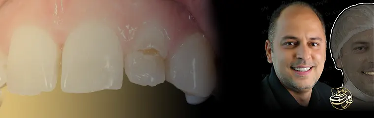 افتادن کامپوزیت دندان