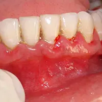 التهاب و قرمزی لصه