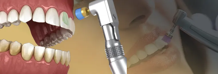پولیش کردن کامپوزیت دندان