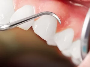 عفونت لثه بعد از کامپوزیت