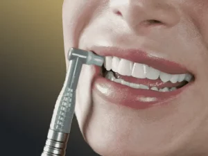 پولیش کامپوزیت دندان