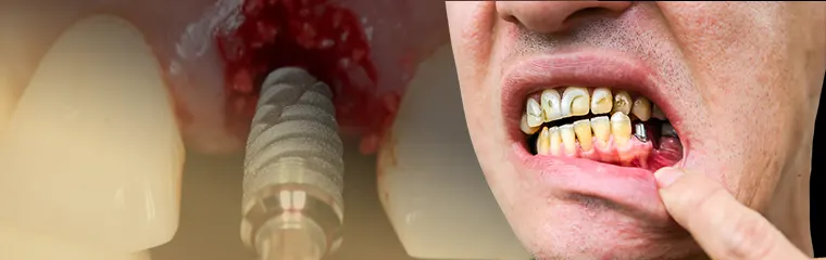 پیوند استخوان بعد از ایمپلنت