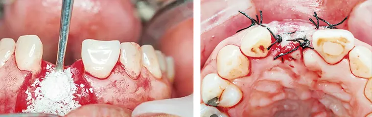 پیوند استخوان پس از ایمپلنت