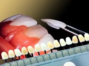 تغییر رنگ لمینت دندان