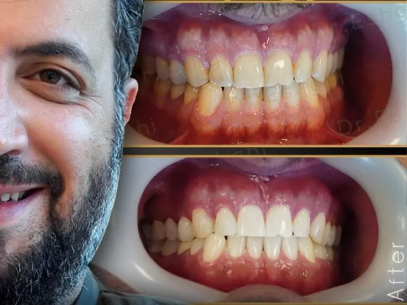 اصلاح فاصله بین دندان ها با کامپوزیت