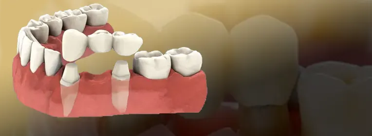 اصلاح فاصله بین دندان با روکش