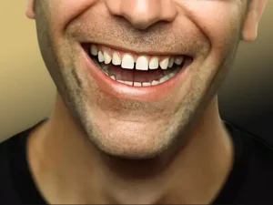 اصلاح فاصله بین دندان ها