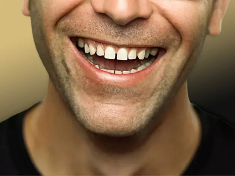 اصلاح فاصله بین دندان ها