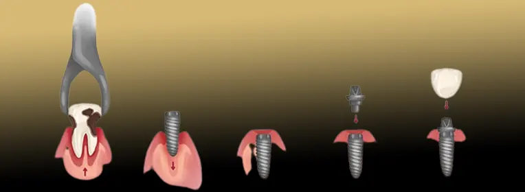 درد ایمپلنت در مراحل مختلف