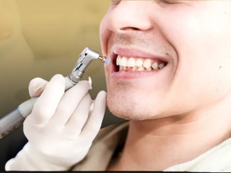 پولیش لمینت دندان