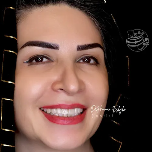 لمینت دندان