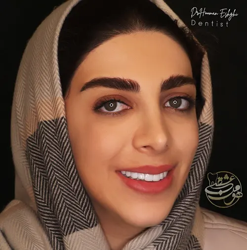 لمینت دندان شکسته