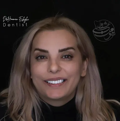 لمینت دندان