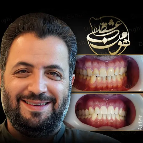 کامپوزیت دندان