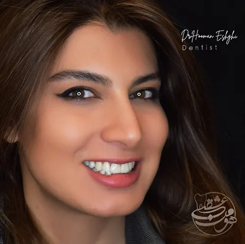 کامپوزیت ونیر