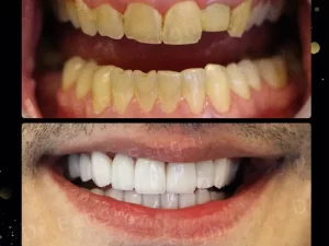 لمینت دندان شکسته