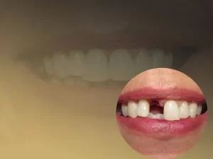 ایمپلنت دندان جلو