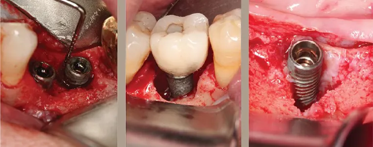 حساسیت ایمپلنت دندانی