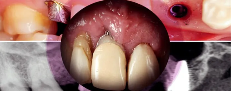 حساسیت به ایمپلنت دندان