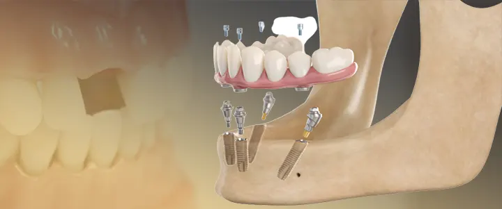 درصد موفقیت ایمپلنت دندان