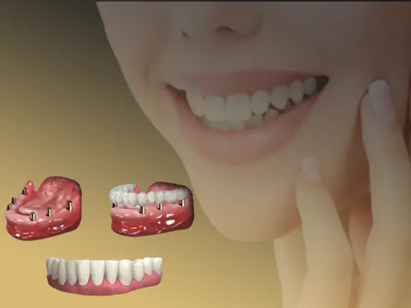 درصد موفقیت ایمپلنت دندان