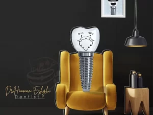 ایمپلنت کل فک