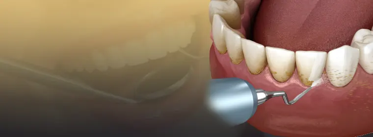 جرم گیری دندان