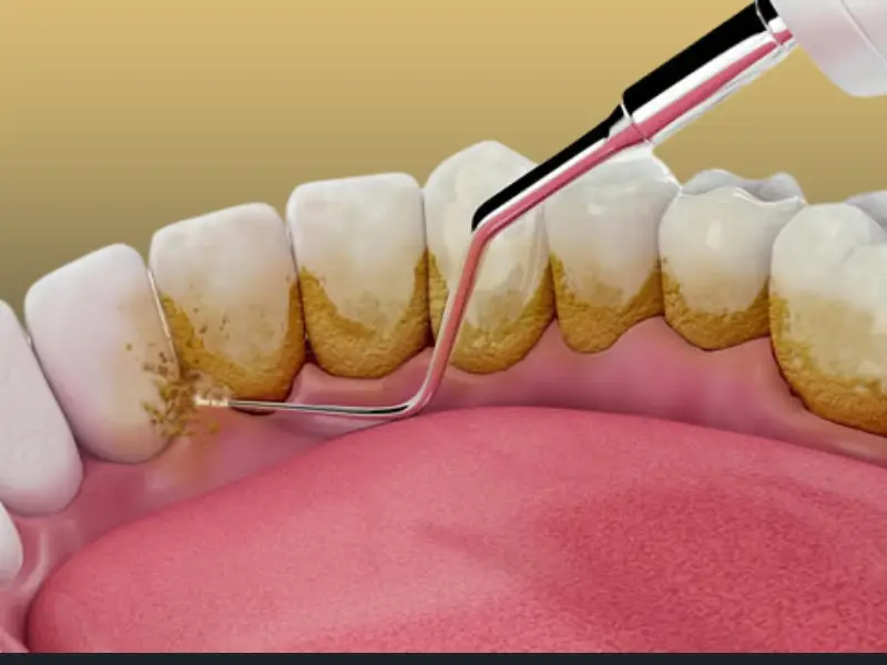 جرم گیری دندان