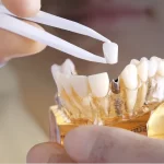 ایمپلنت دندان بدون جراحی