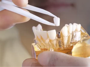 ایمپلنت دندان بدون جراحی