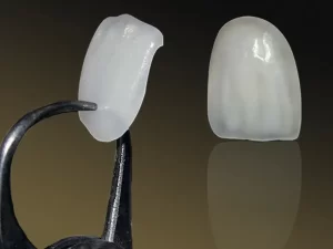 ضخامت لمینت دندان