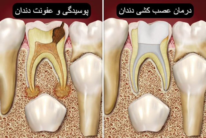 عصب کشی دندان شیری