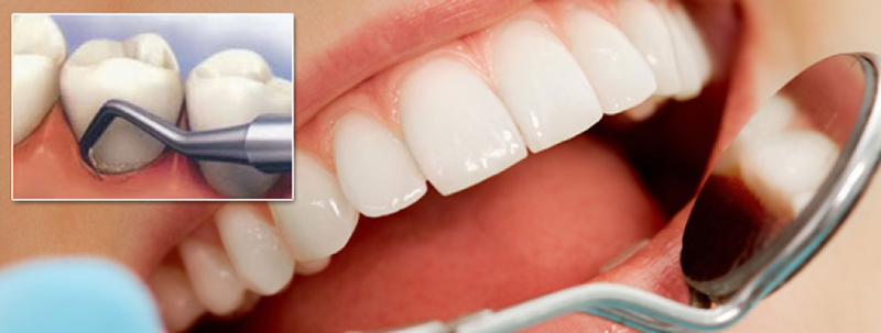 تفاوت بلیچینگ و جرم گیری