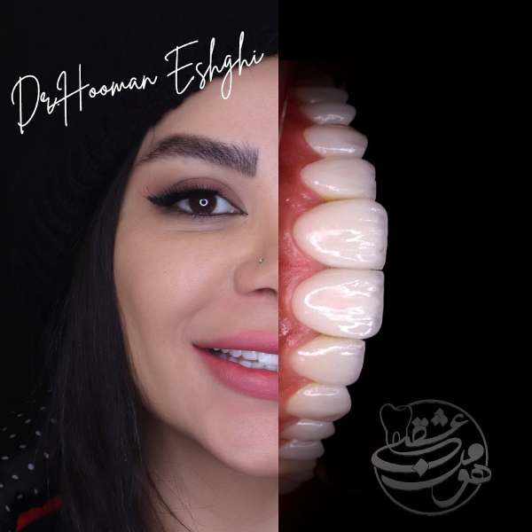 لمینت دندان کج