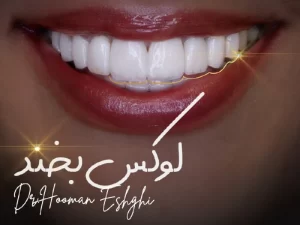 کامپوزیت دندان خرگوشی