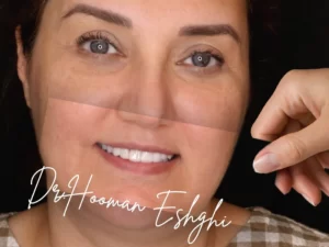 لمینت دندان کج