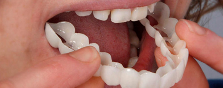 لمینت متحرک دندان