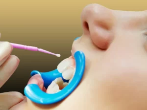 فلوراید تراپی