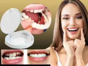 لمینت متحرک دندان