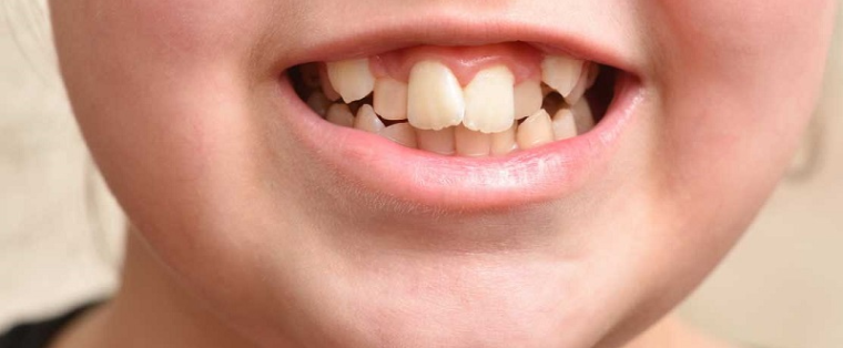 کج شدن دندان کودکان