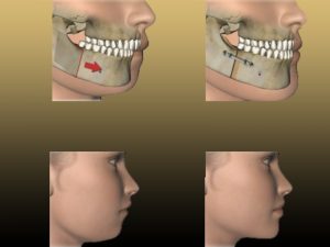 ارتودنسی کاموفلاژ