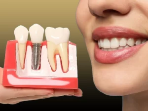 ایمپلنت دندان پوسیده