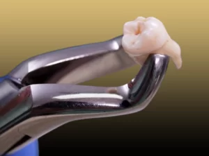 جراحی دندان عقل