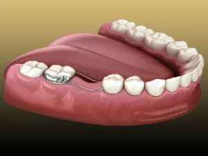 فضا نگهدارنده دندان کودکان