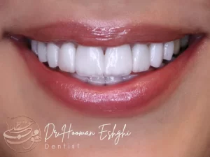 لمینت شیشه ای دندان