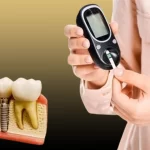 ایمپلنت در افراد دیابتی