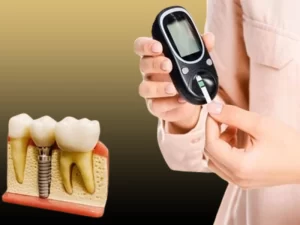 ایمپلنت در افراد دیابتی